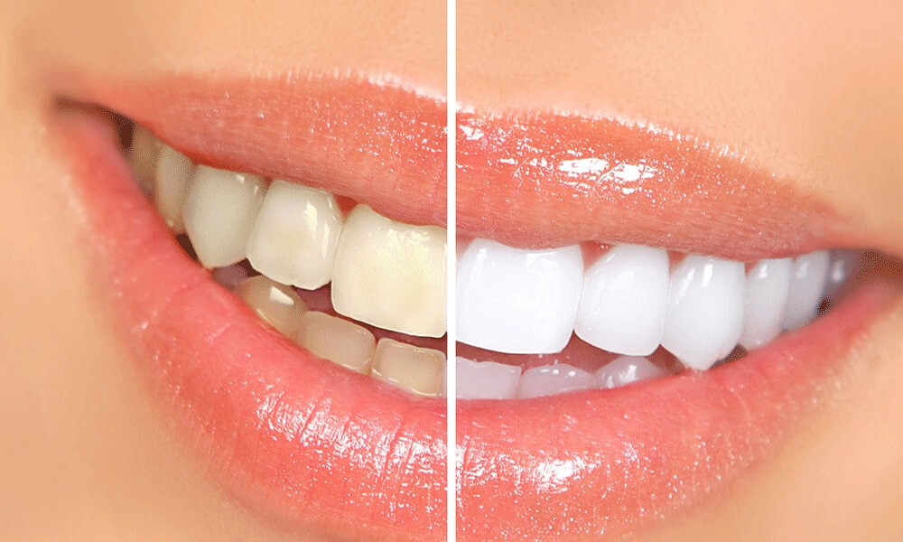 Teeth Whitening